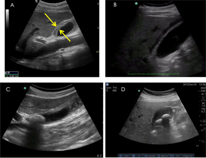 Gallbladder