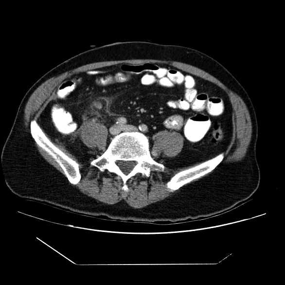 CT of Appendicitis