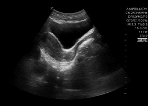 Ovarian Torsion 2