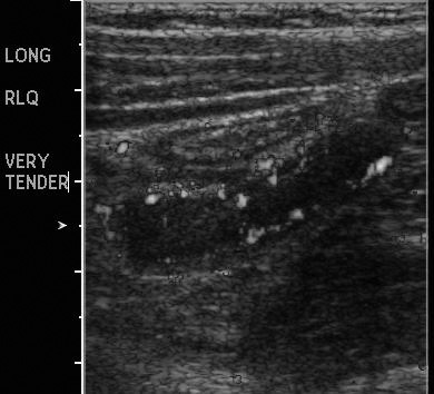 Ultrasound of Appendicitis
