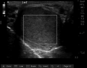 Testicular Torsion 1