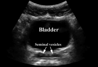 Testicular Torsion 2