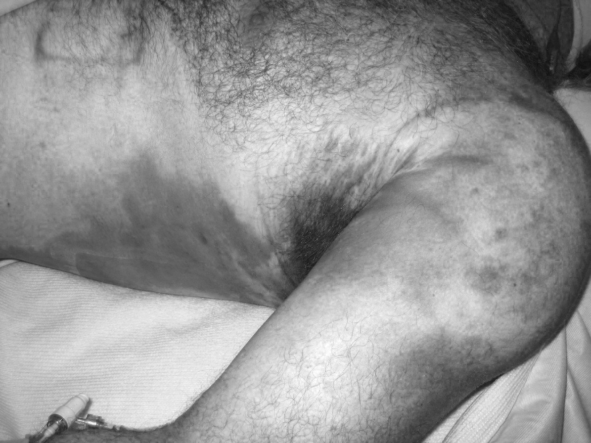 Necrotizing Fasciitis