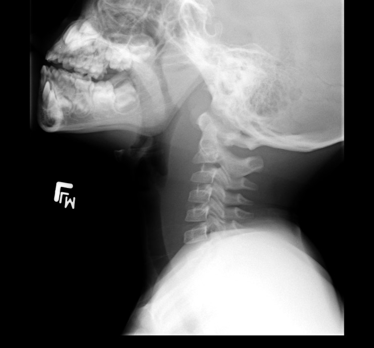 Radiograph RPA