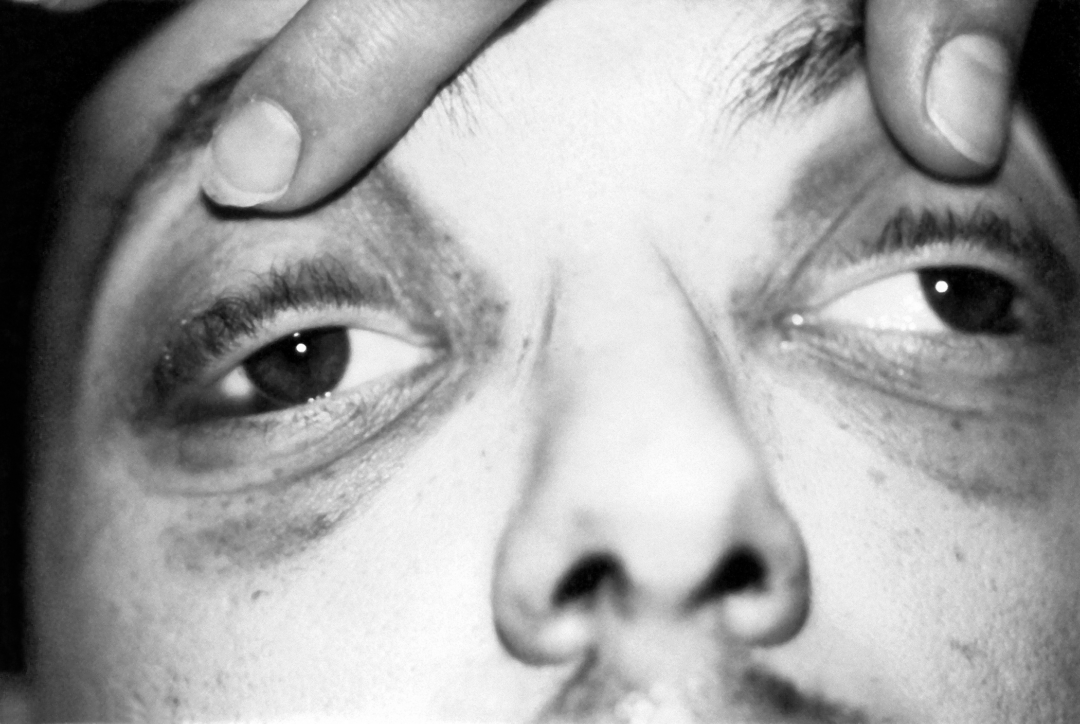 raccoon eyes
