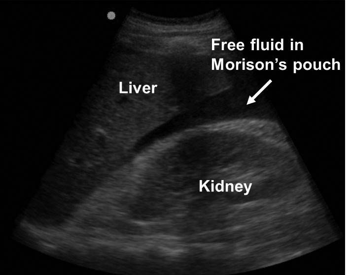 Morison's pouch
