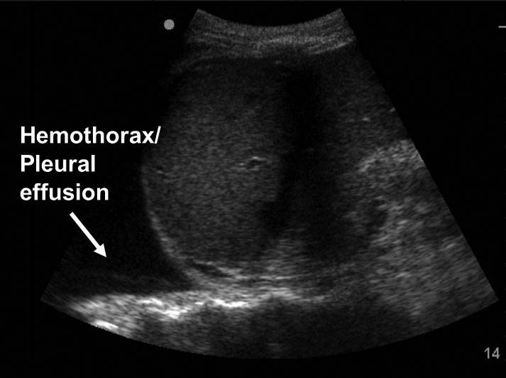 Hemothorax