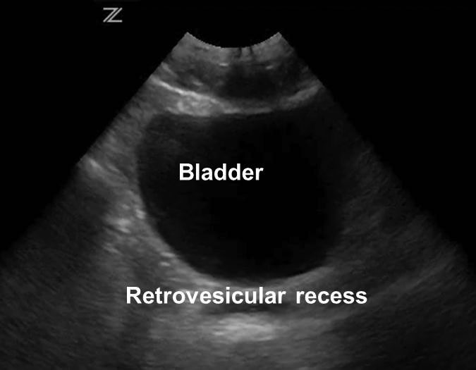 Normal suprapubic