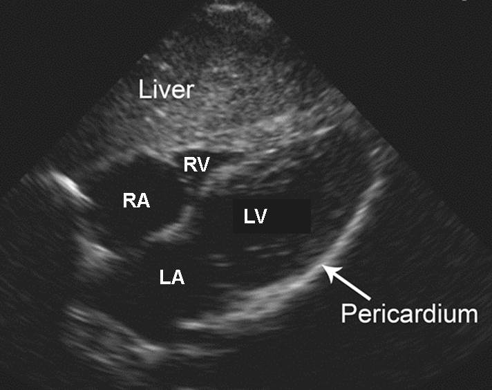 Normal subxiphoid