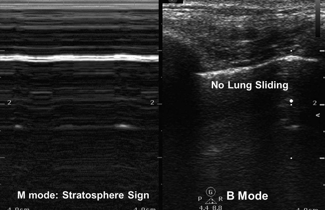 Pneumothorax