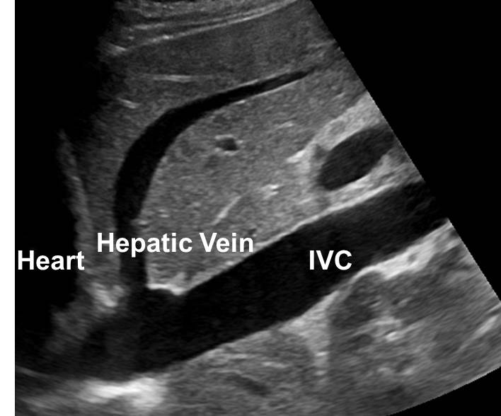 IVC