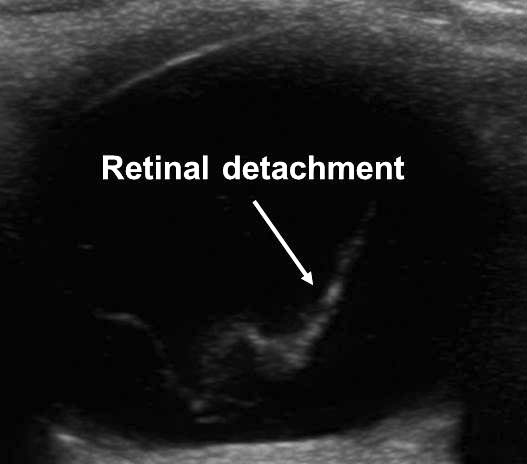 Retinal detachment