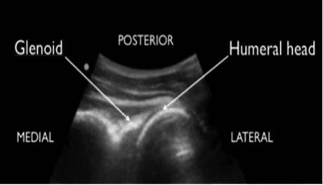 Normal shoulder