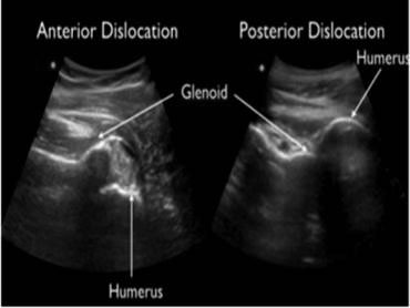 Shoulder dislocations