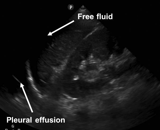 Pleural effusion