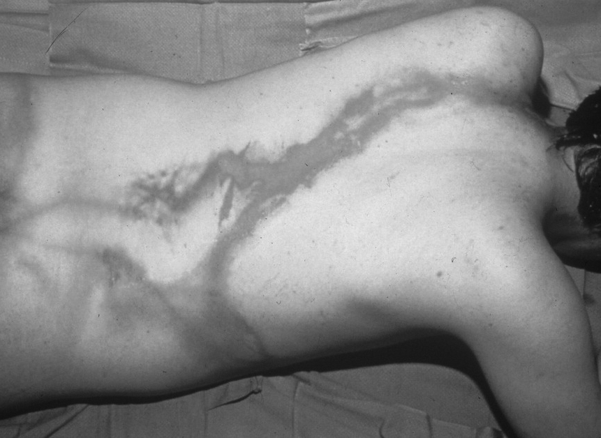 linear burns