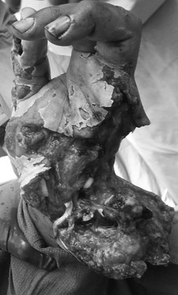 upper extremity injury
