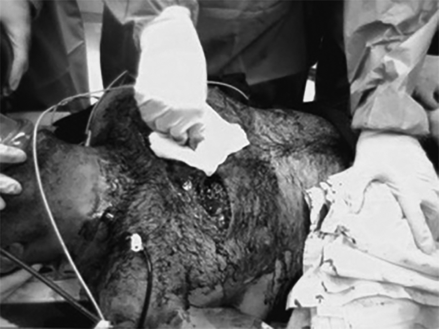 open pneumothorax