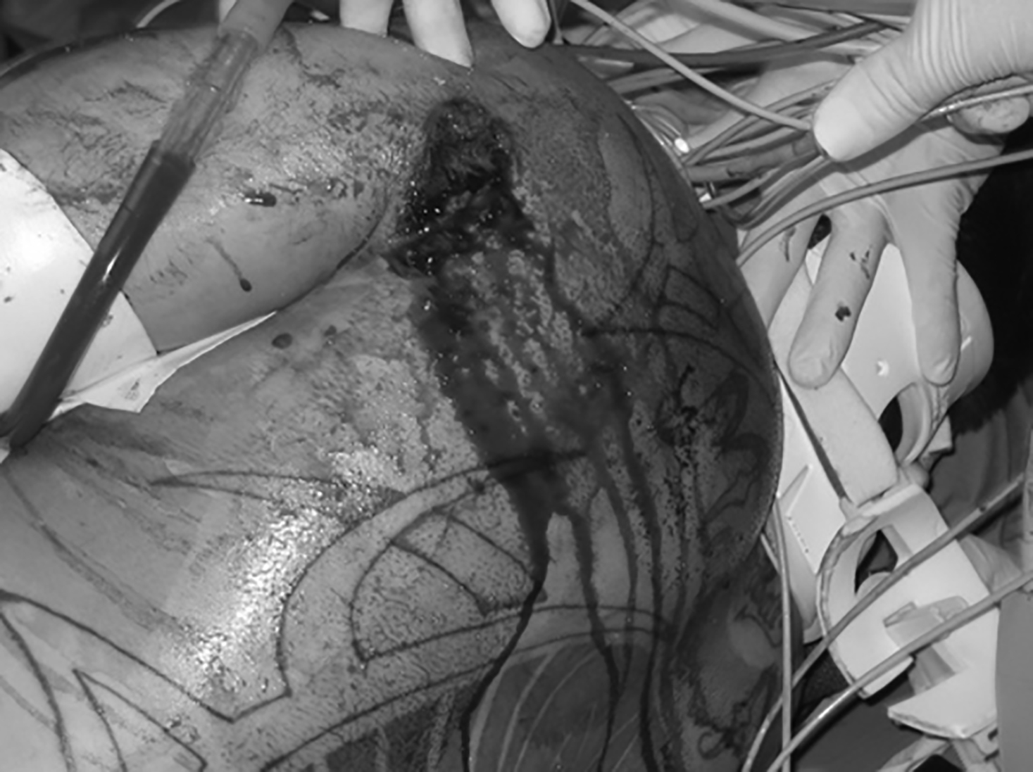 penetrating chest trauma