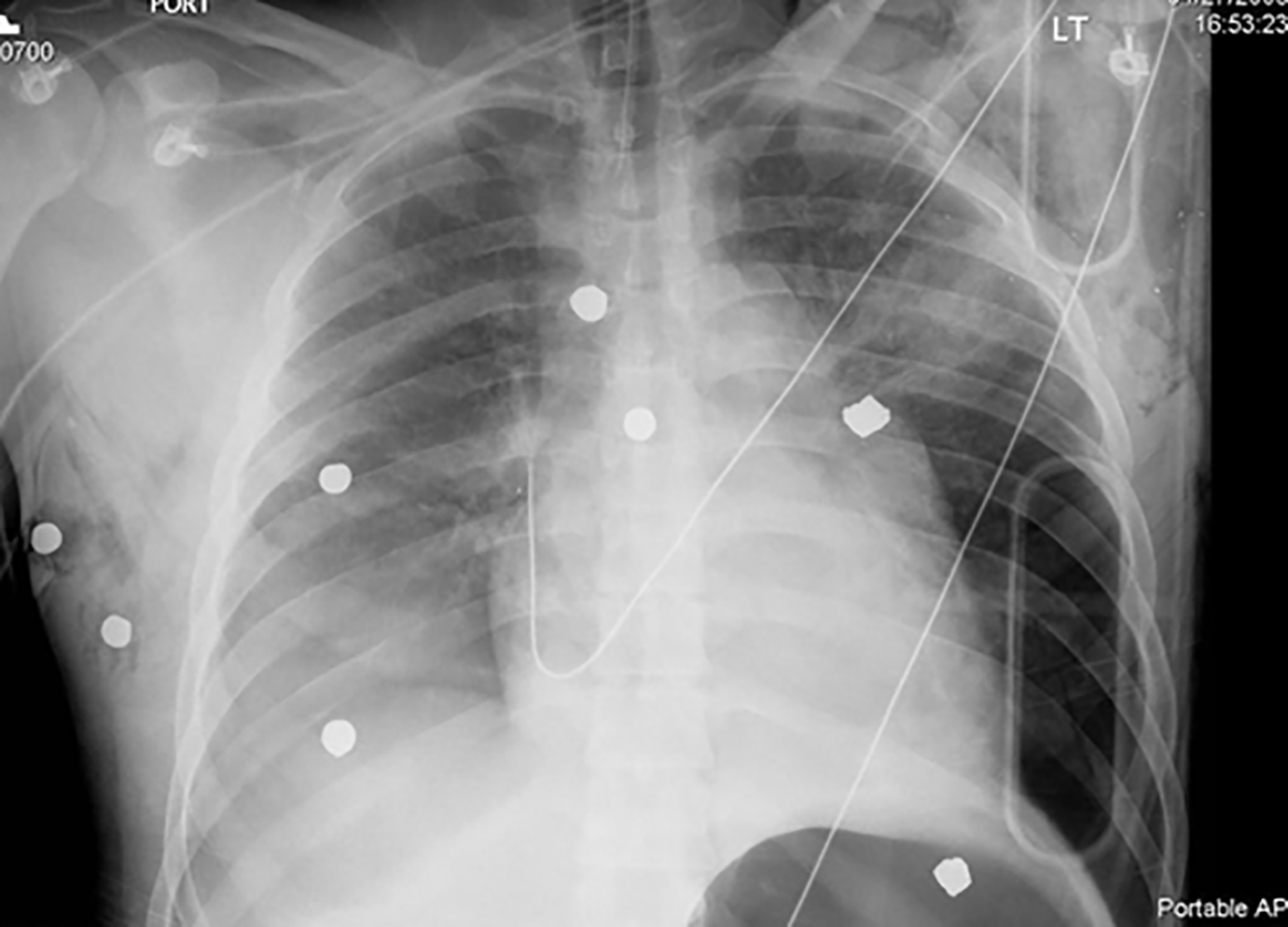 hemothorax