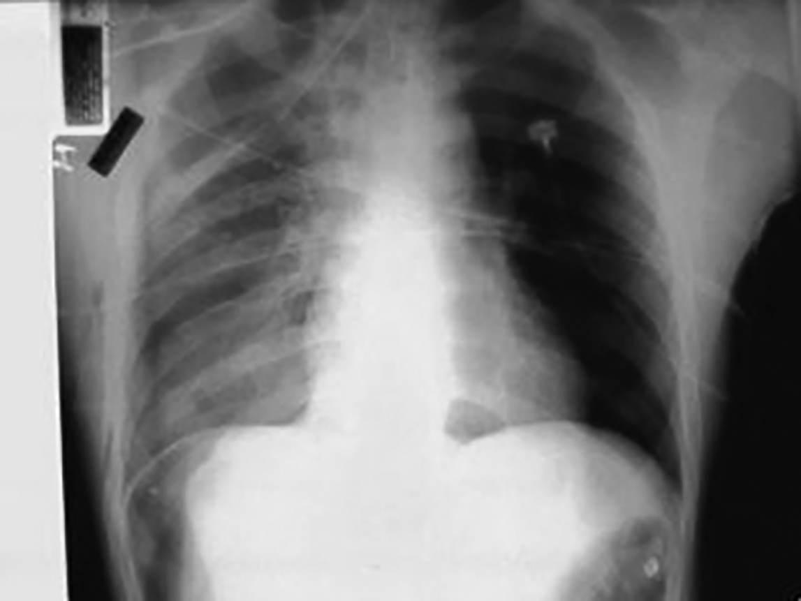 hemopneumothorax
