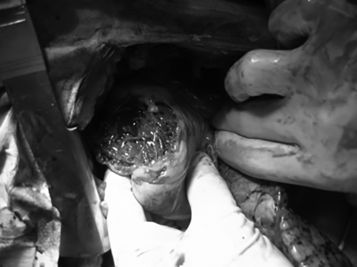 penetrating cardiac injury