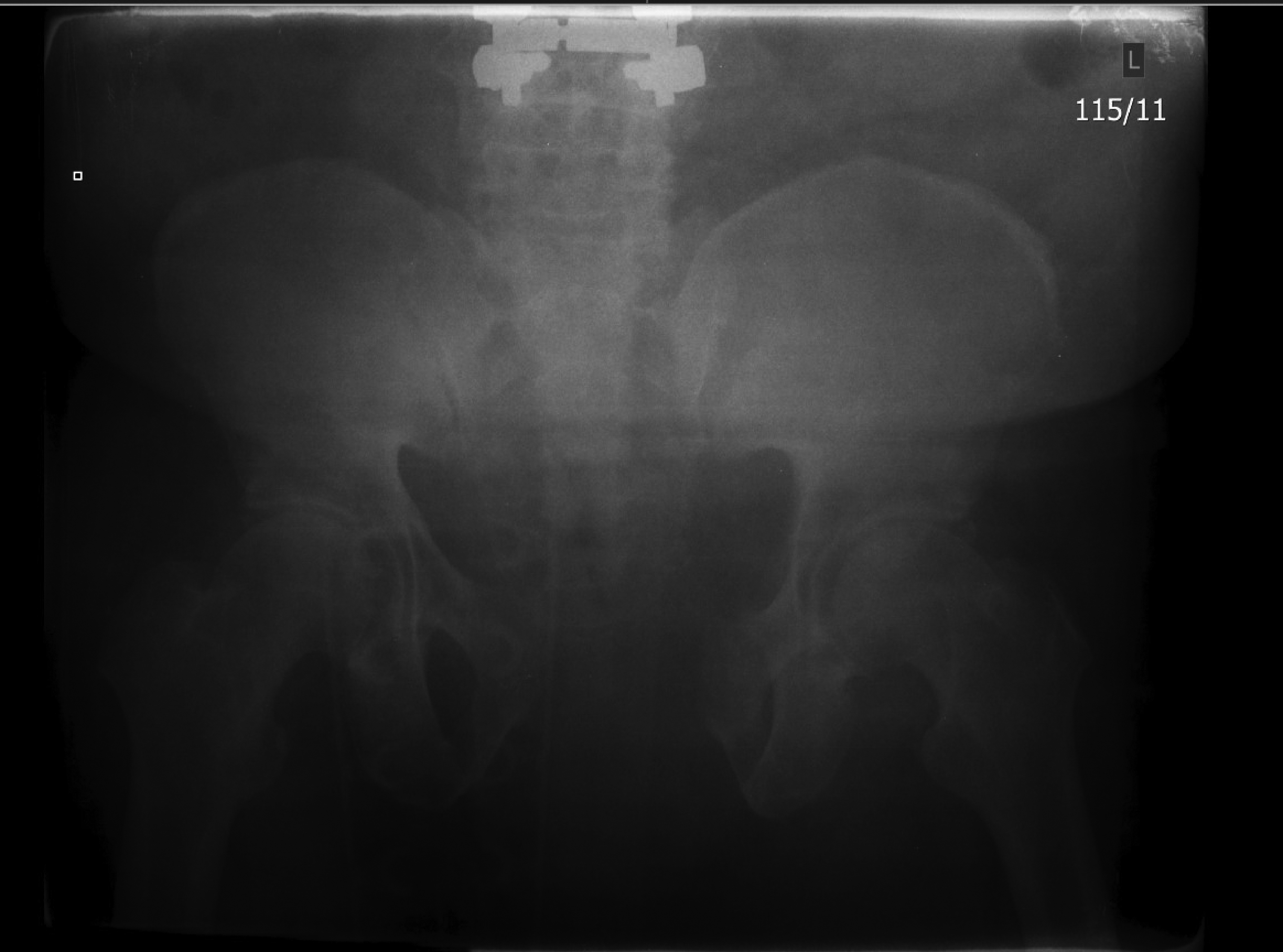 Pelvic fracture