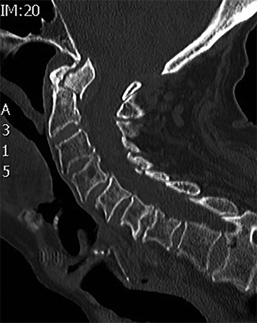Dens Fracture