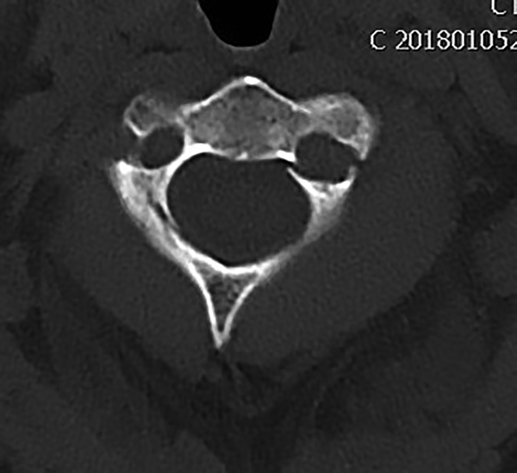 Fracture involving transverse foramen