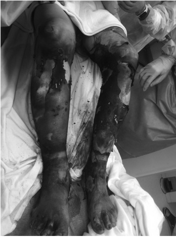 Lower extremity burns
