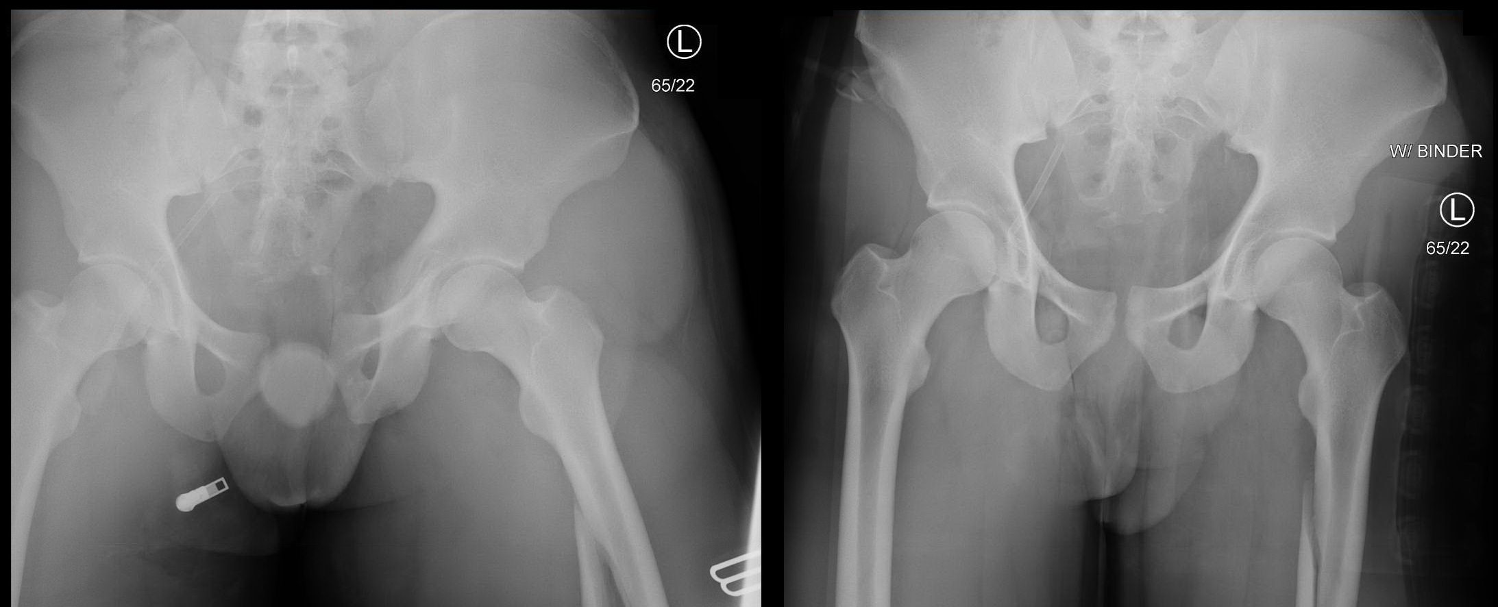 APC3 Fracture