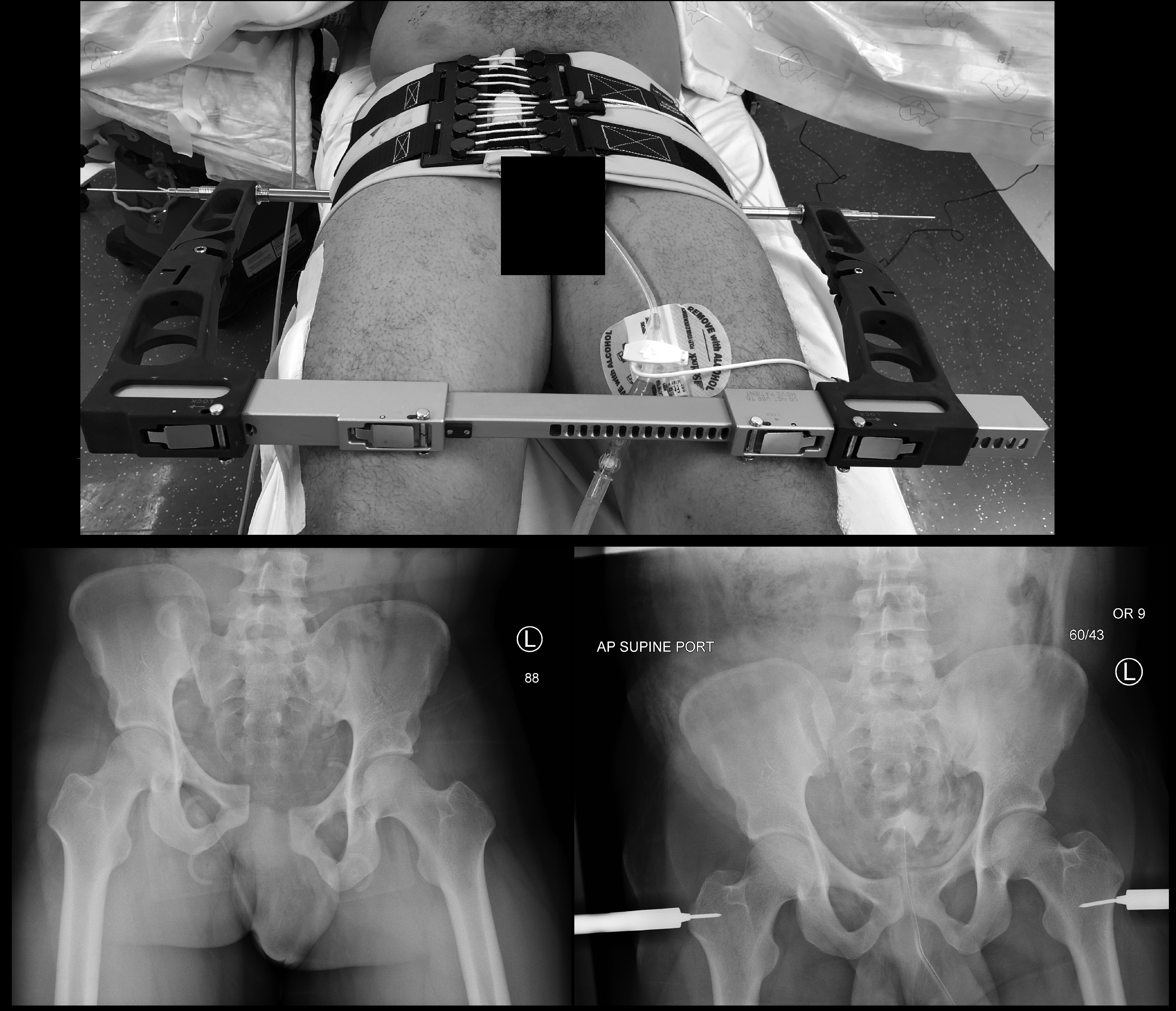 Vertical shear fracture