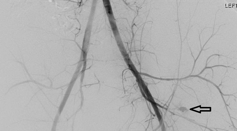 Angiography of pelvis