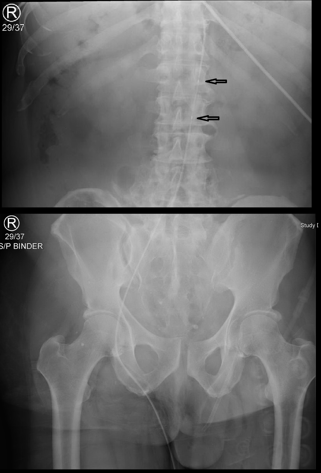 REBOA Placement