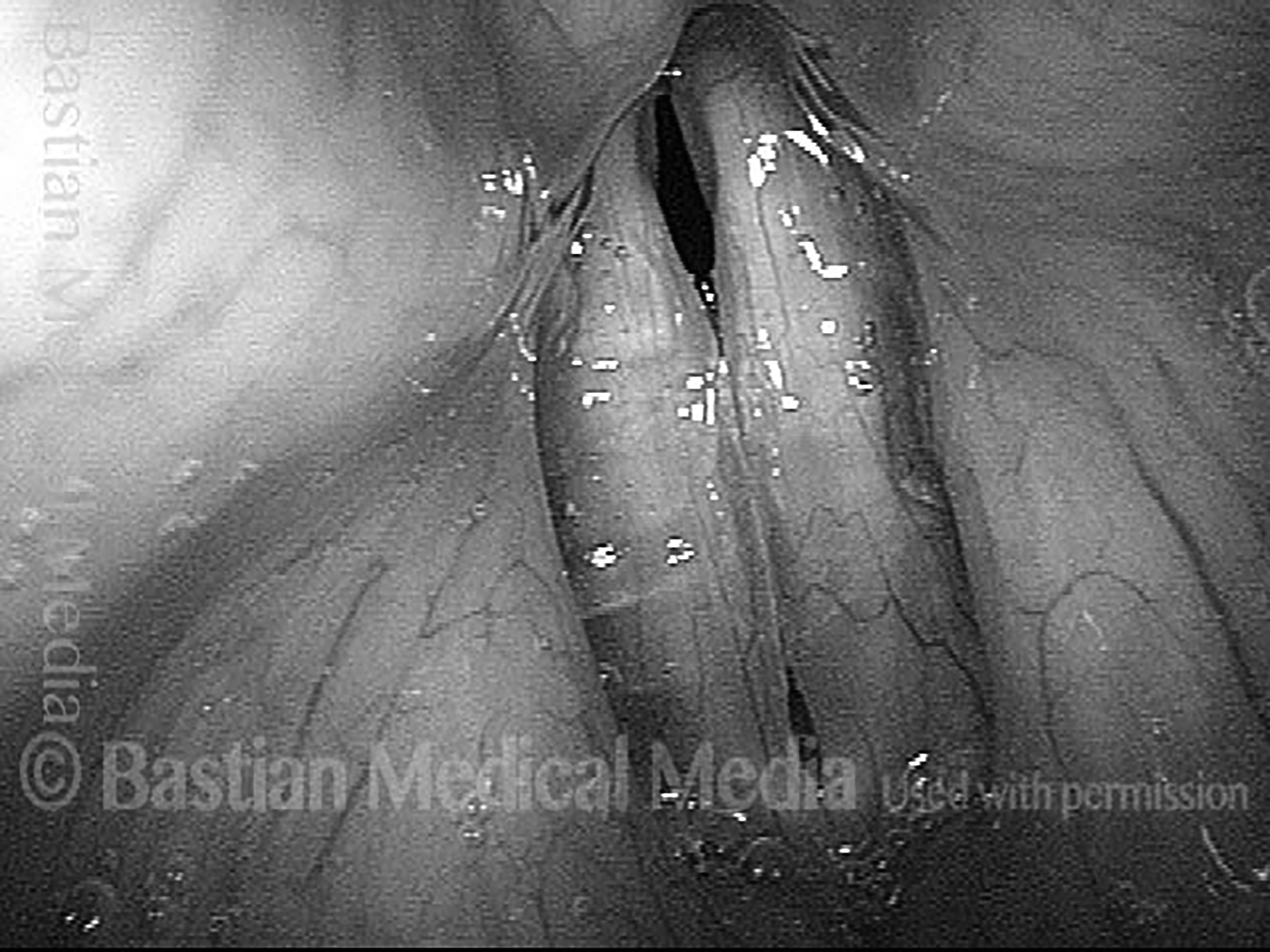 Presbylarynx